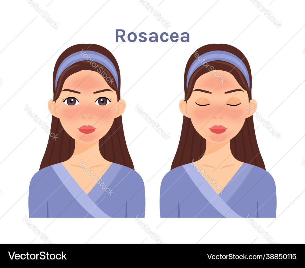 Rosacea skin diseases face cute woman portrait Rosacea skin diseases face cute woman portrait vector image