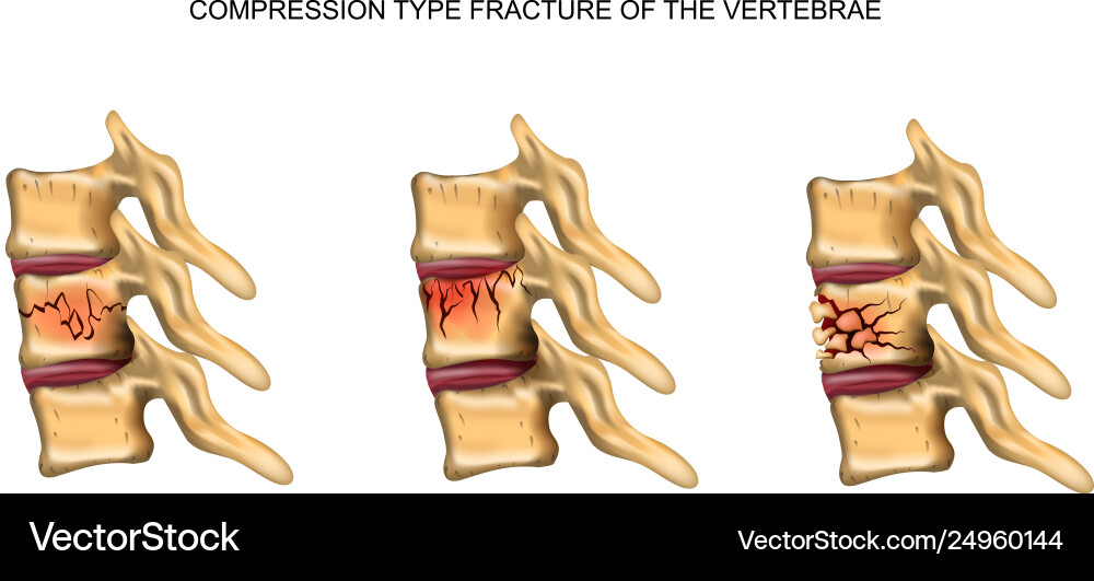 Compression type fracture spine Compression type fracture spine vector image