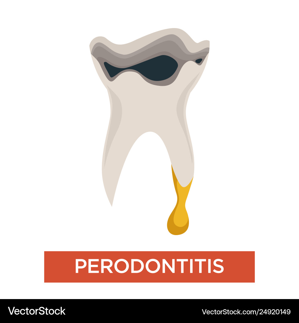 Periodontitis ill tooth dentistry mouth cavity Periodontitis ill tooth dentistry mouth cavity vector image