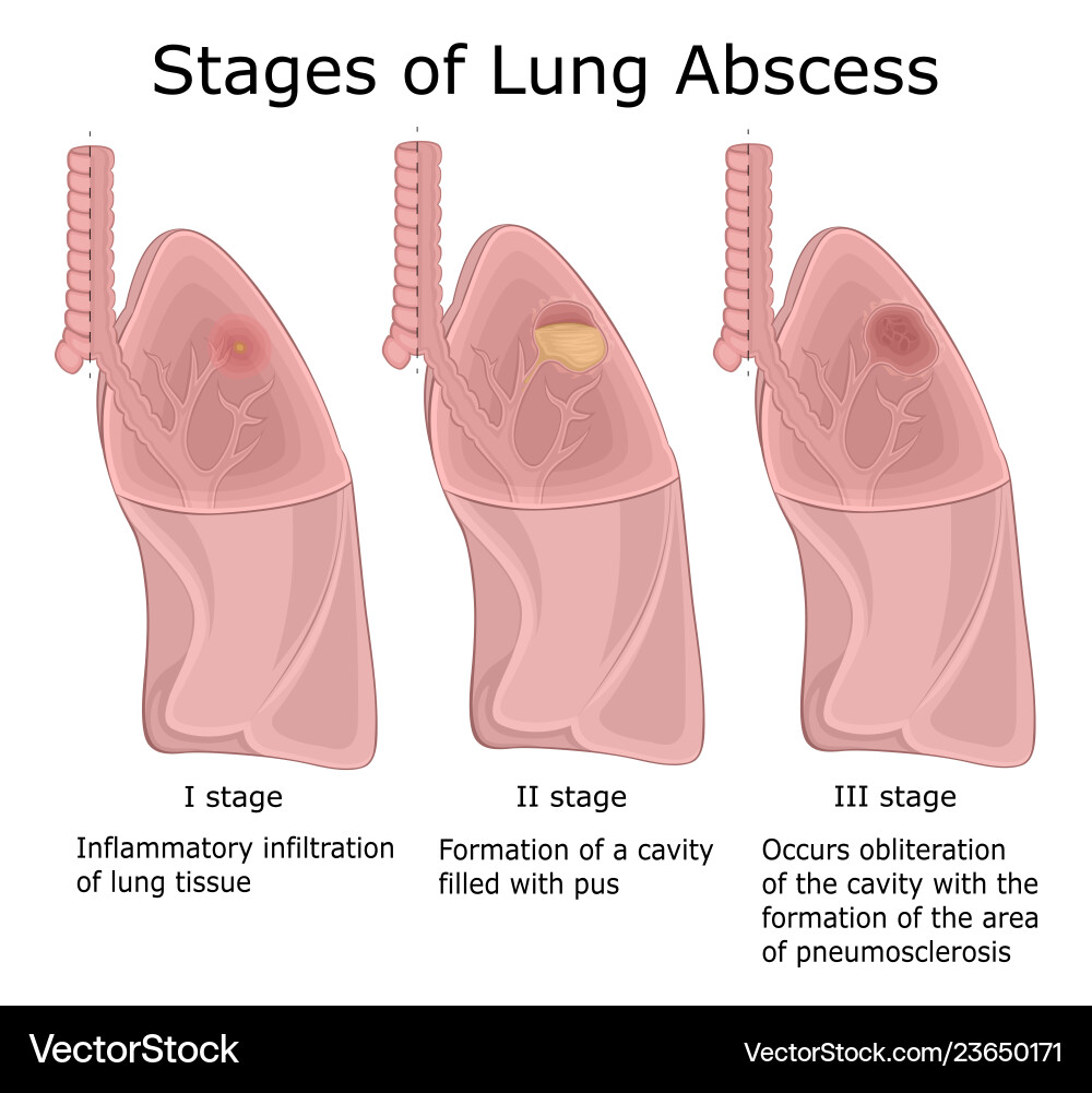 Stages of lung abscess Stages of lung abscess vector image