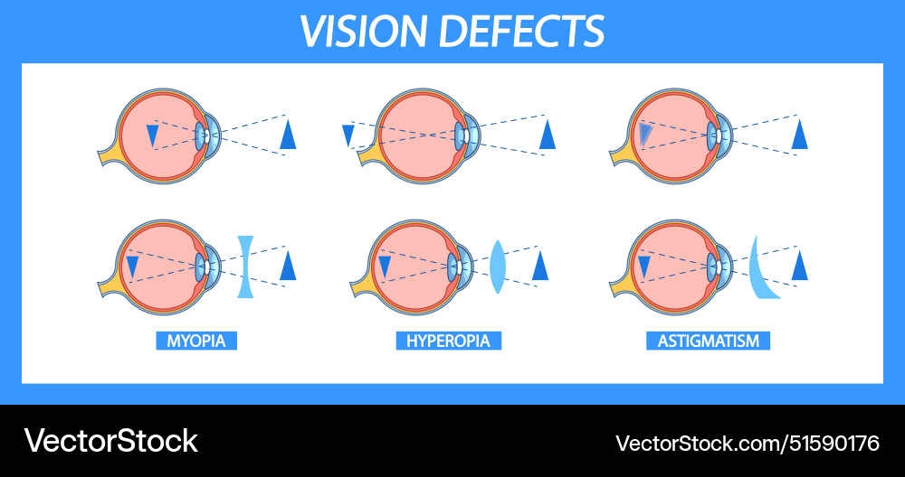 Informative chart detailing myopia hyperopia Vector Image