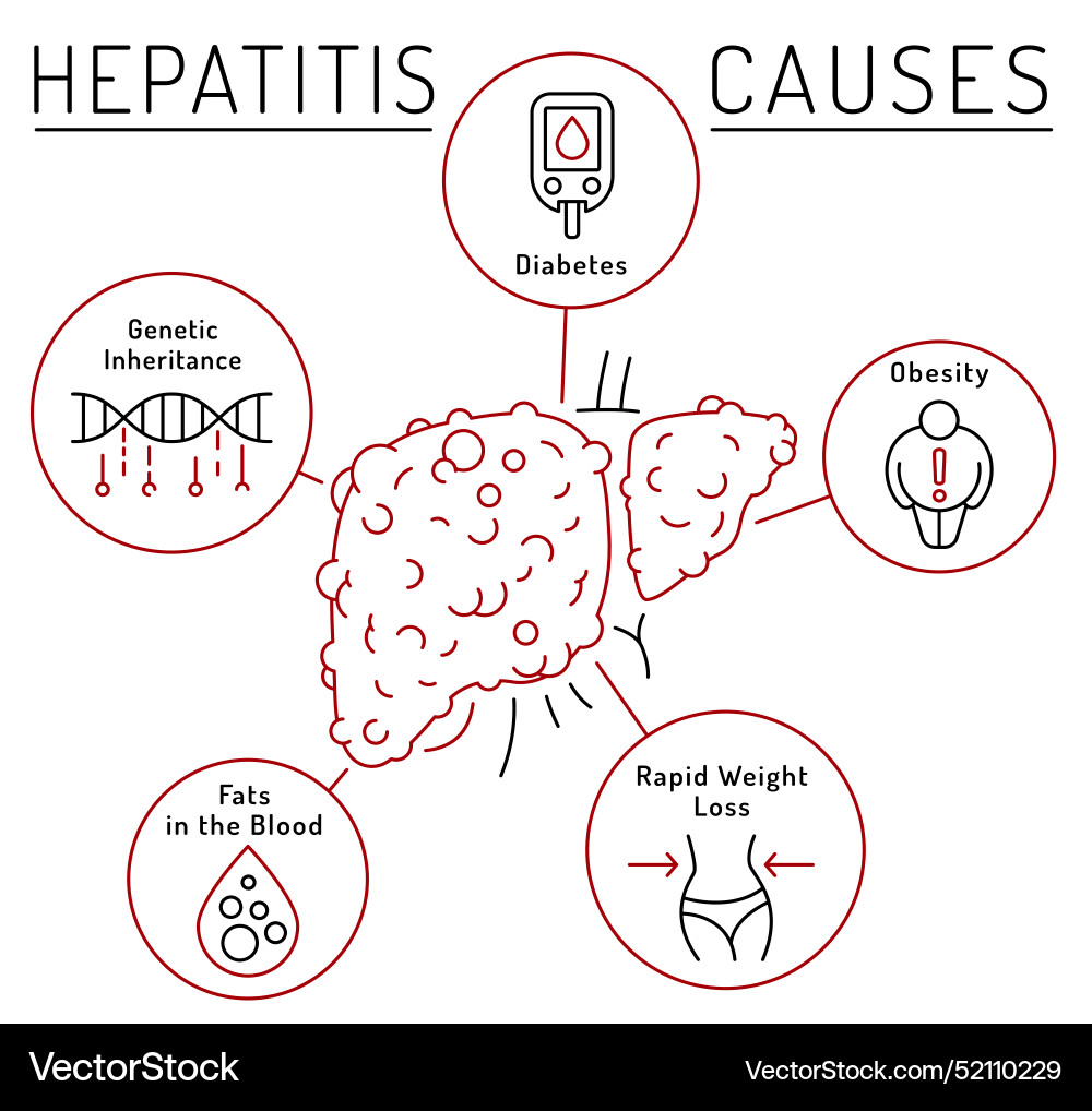 Causes of hepatitis hep precaution Causes of hepatitis hep precaution vector image