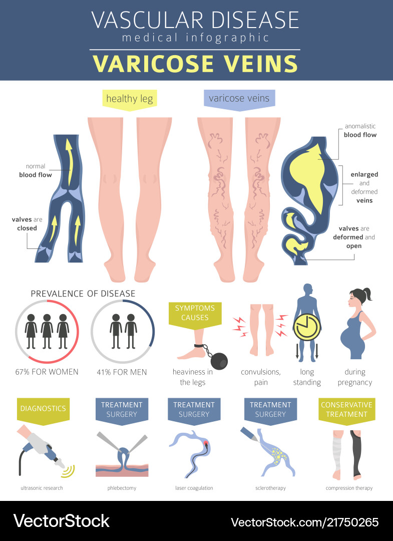 Vascular diseases varicose veins symptoms Vascular diseases varicose veins symptoms vector image
