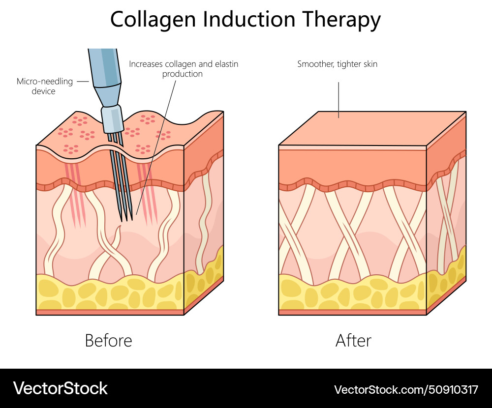 Collagen induction therapy before after diagram Vector Image