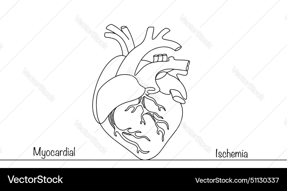 Ischemia Royalty Free Vector Image VectorStock