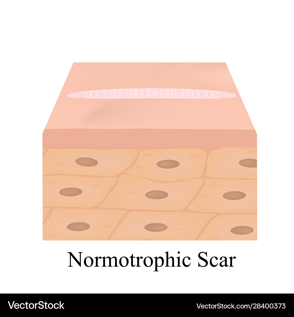 Narben normotroph die anatomische Struktur Narben normotroph die anatomische Struktur vektorbild
