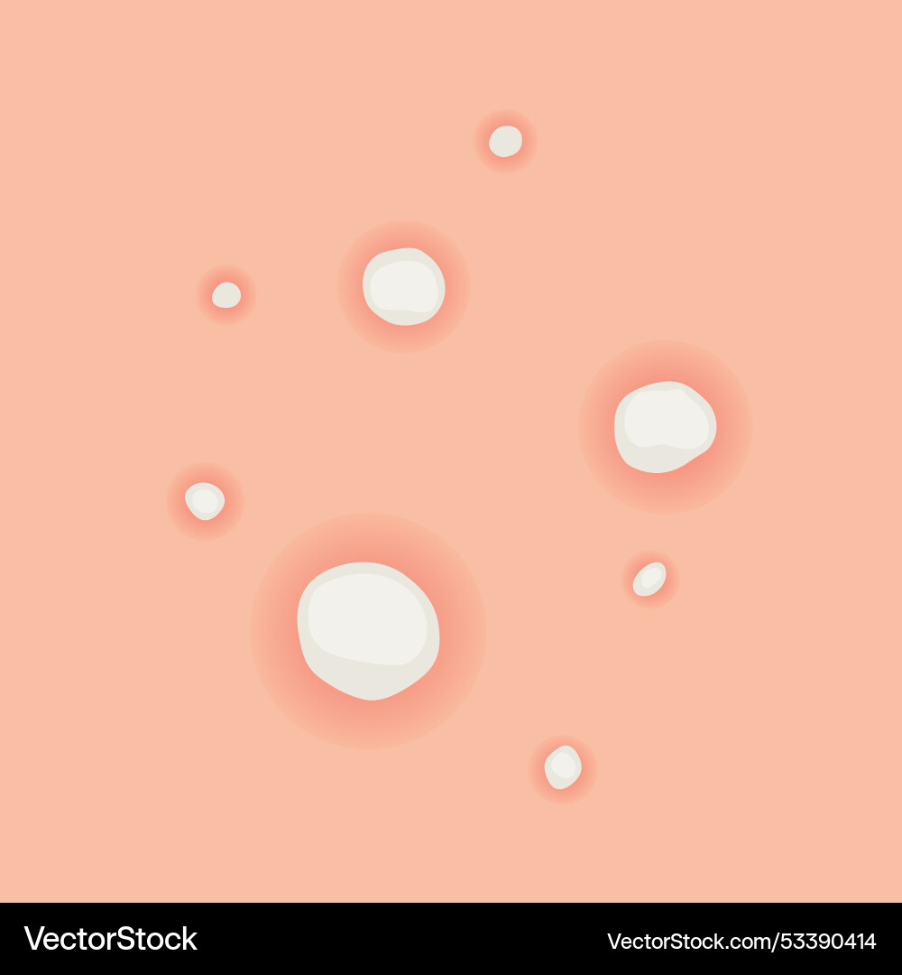 Understanding type of acne a comprehensive visual Vector Image
