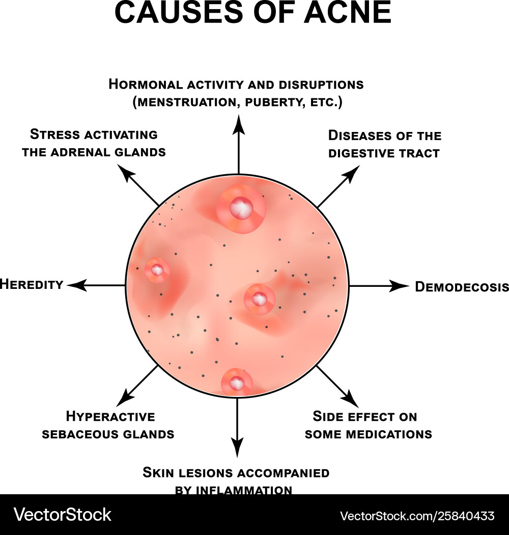 Causes acne pustules papules comedones Causes acne pustules papules comedones vector image