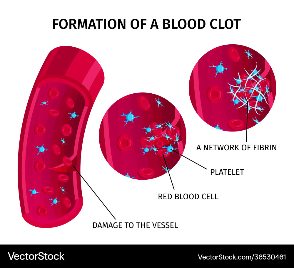 Blood cells thrombus infographics vector image