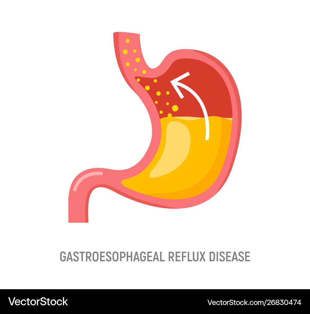 Gastroesophageal reflux disease stomach gerd Gastroesophageal reflux disease stomach gerd vector image