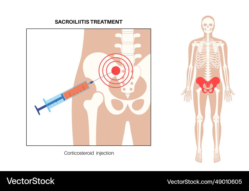 Sacroiliitis corticosteroid injections Sacroiliitis corticosteroid injections vector image