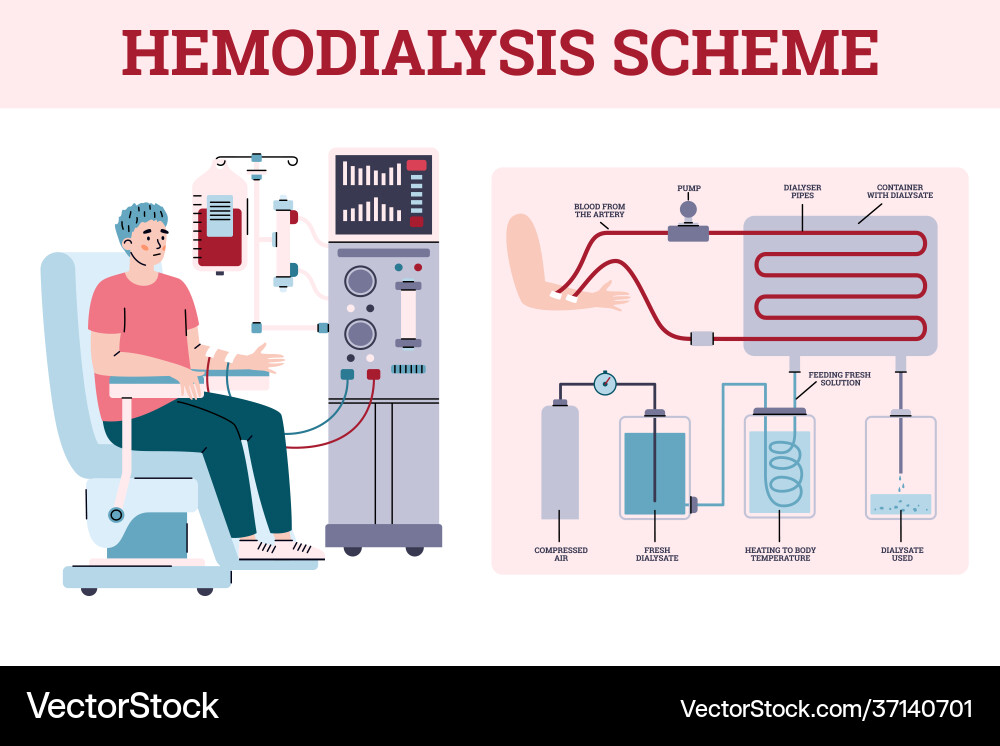 Hemodialysis renal scheme with equipment Hemodialysis renal scheme with equipment vector image