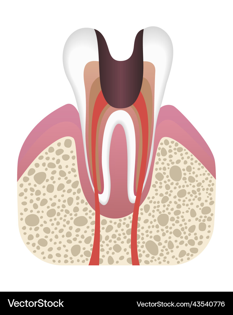 Stage of caries development tooth structure Stage of caries development tooth structure vector image