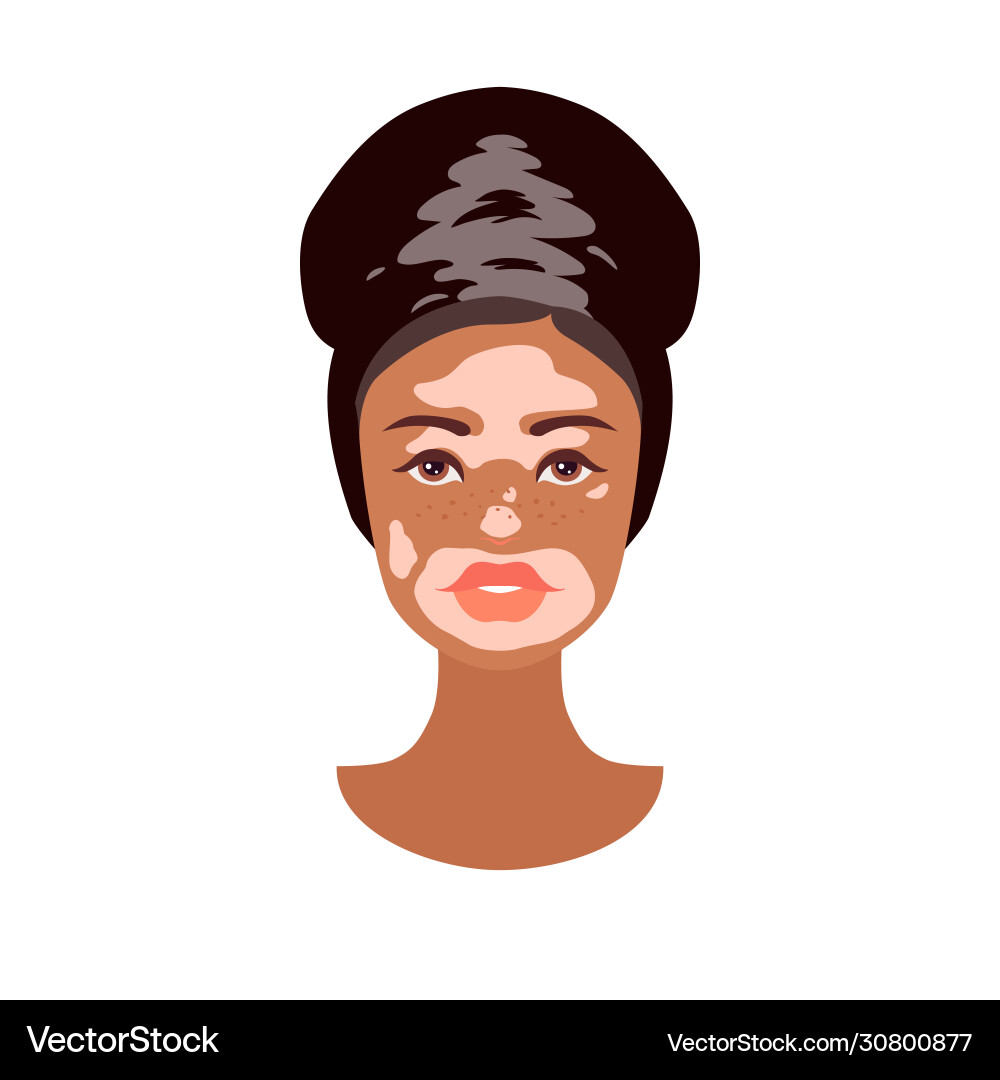 Schöne junge afrikanische Frau Gesicht mit Vitiligo Schöne junge afrikanische Frau Gesicht mit Vitiligo vektorbild