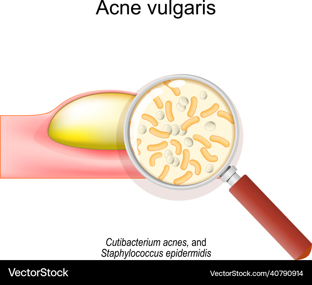 Acne vulgaris cross-section of a human skin Acne vulgaris cross-section of a human skin vector image