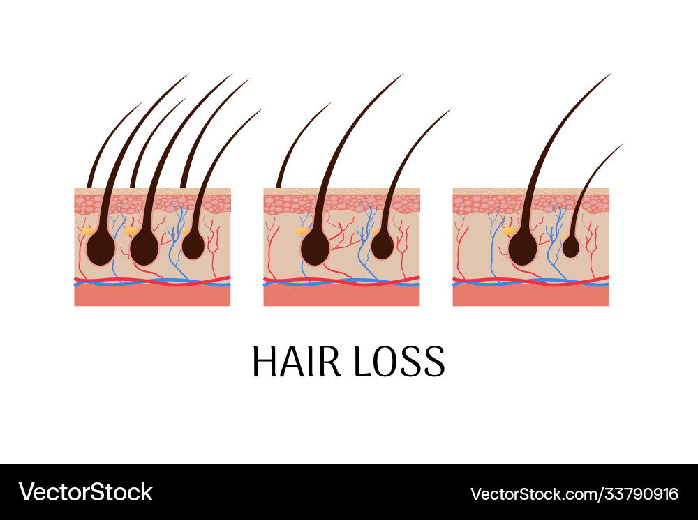 Anatomisches Konzept Haarausfall Stufen Anatomisches Konzept Haarausfall Stufen vektorbild