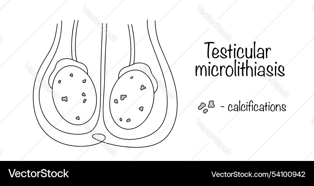 Testicular Microlithiasis - Calcifications Vector Image