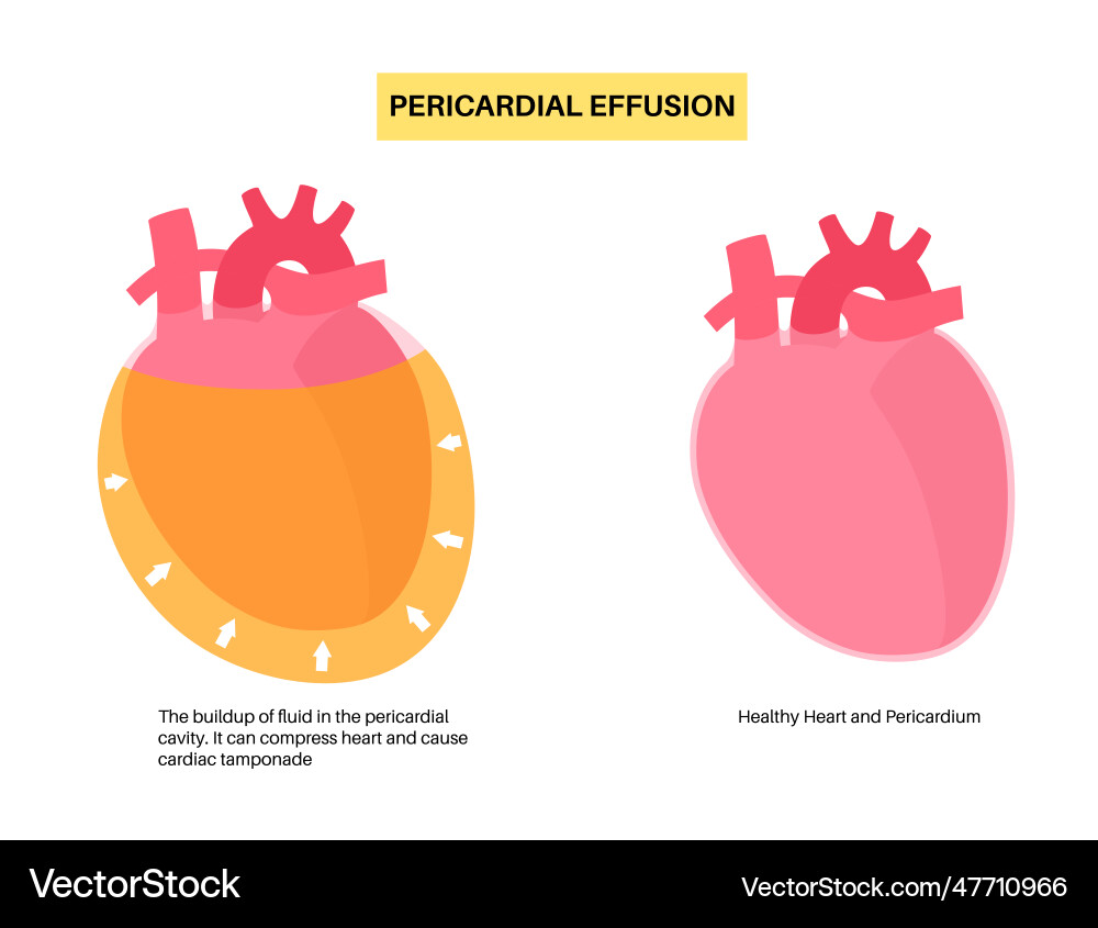 Pericardial effusion heart vector image