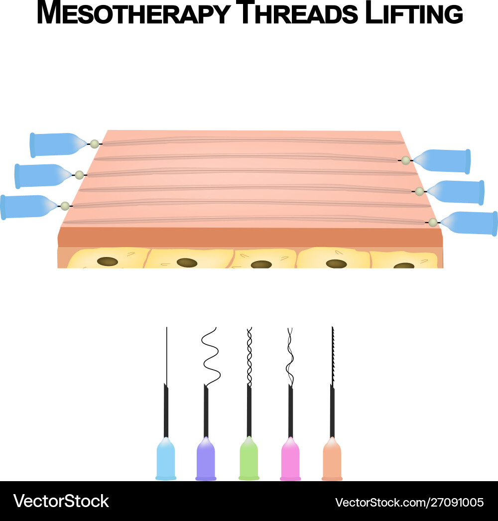Mesotherapy threads lifting different types Vector Image