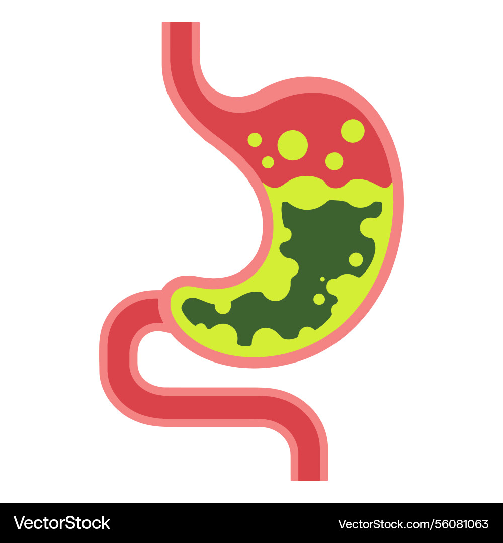 Menschlicher Magen zeigt Gastritis Säure Rückfluss Menschlicher Magen zeigt Gastritis Säure Rückfluss vektorbild
