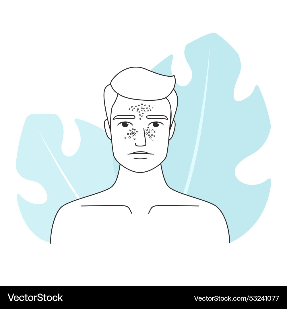 Man with melasma and hyperpigmentation vector image