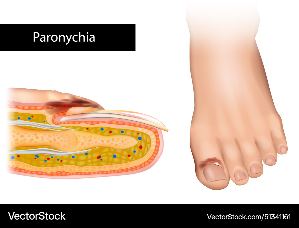 Paronychia is an inflammation of the skin around Paronychia is an inflammation of the skin around vector image