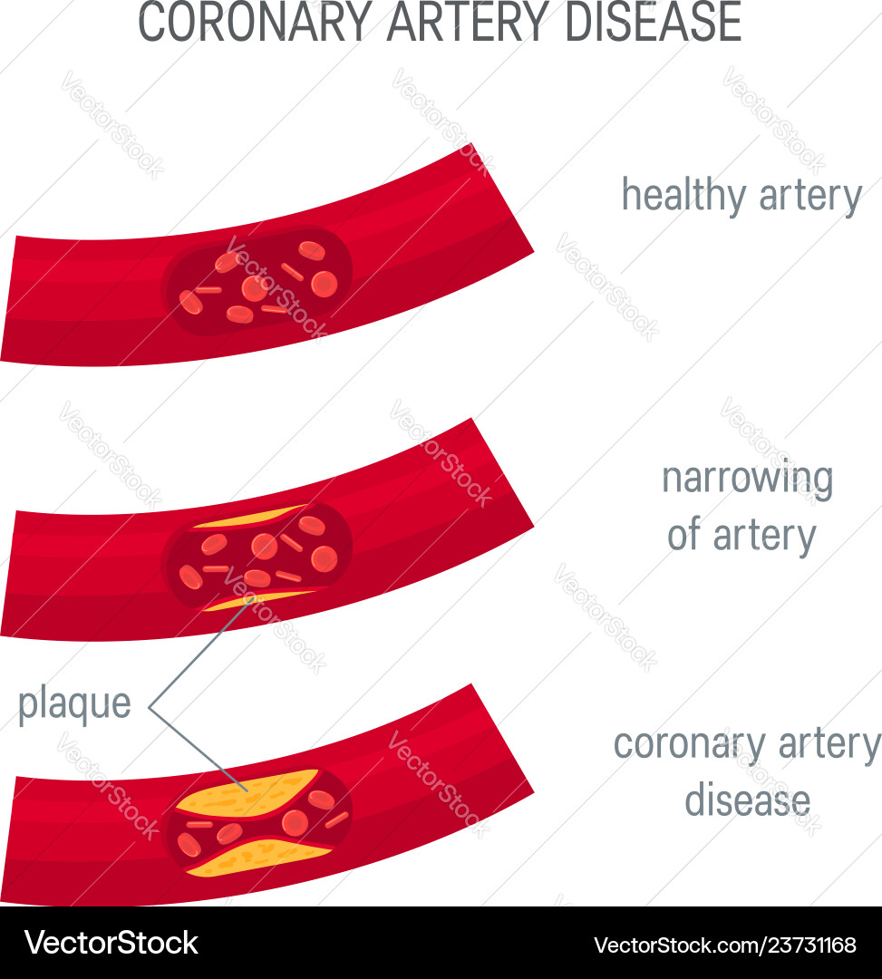 Coronary Artery Disease Concept In Flat Style Vector Image