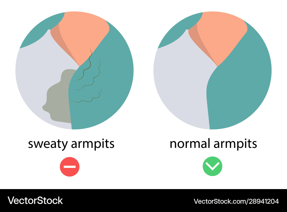 Hyperhidrosis wet armpits excessive sweating Hyperhidrosis wet armpits excessive sweating vector image