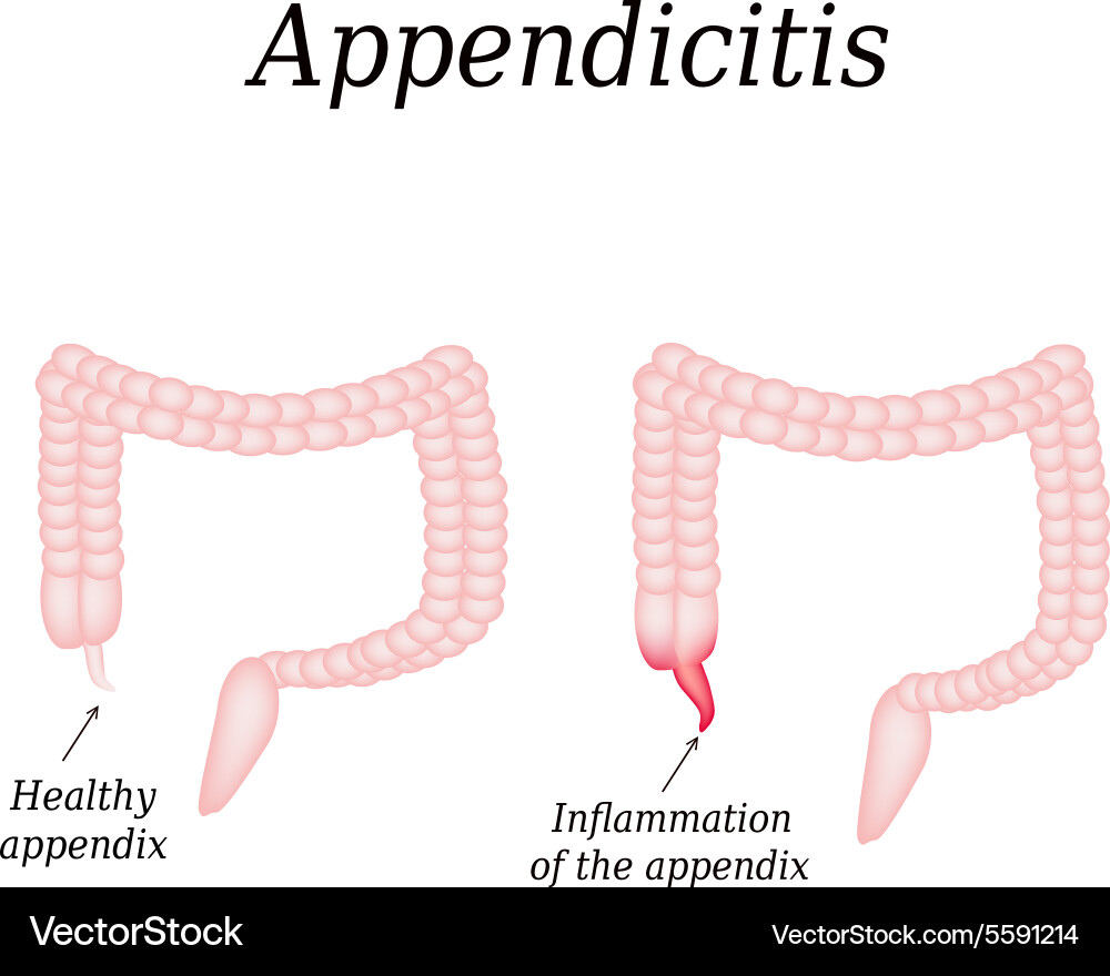 Appendicitis inflammation of the appendix colon vector image