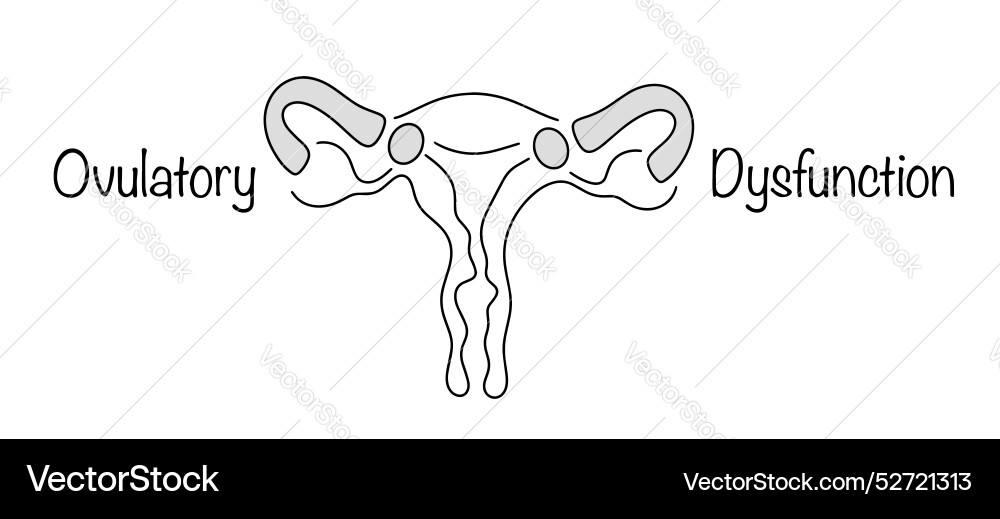 Ovulatory dysfunction Royalty Free Vector Image