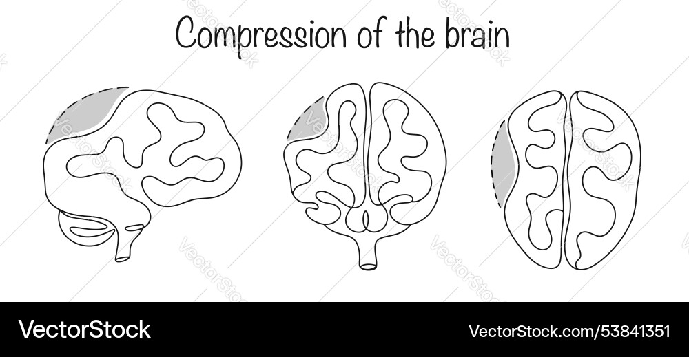 Compression of the brain Compression of the brain vector image