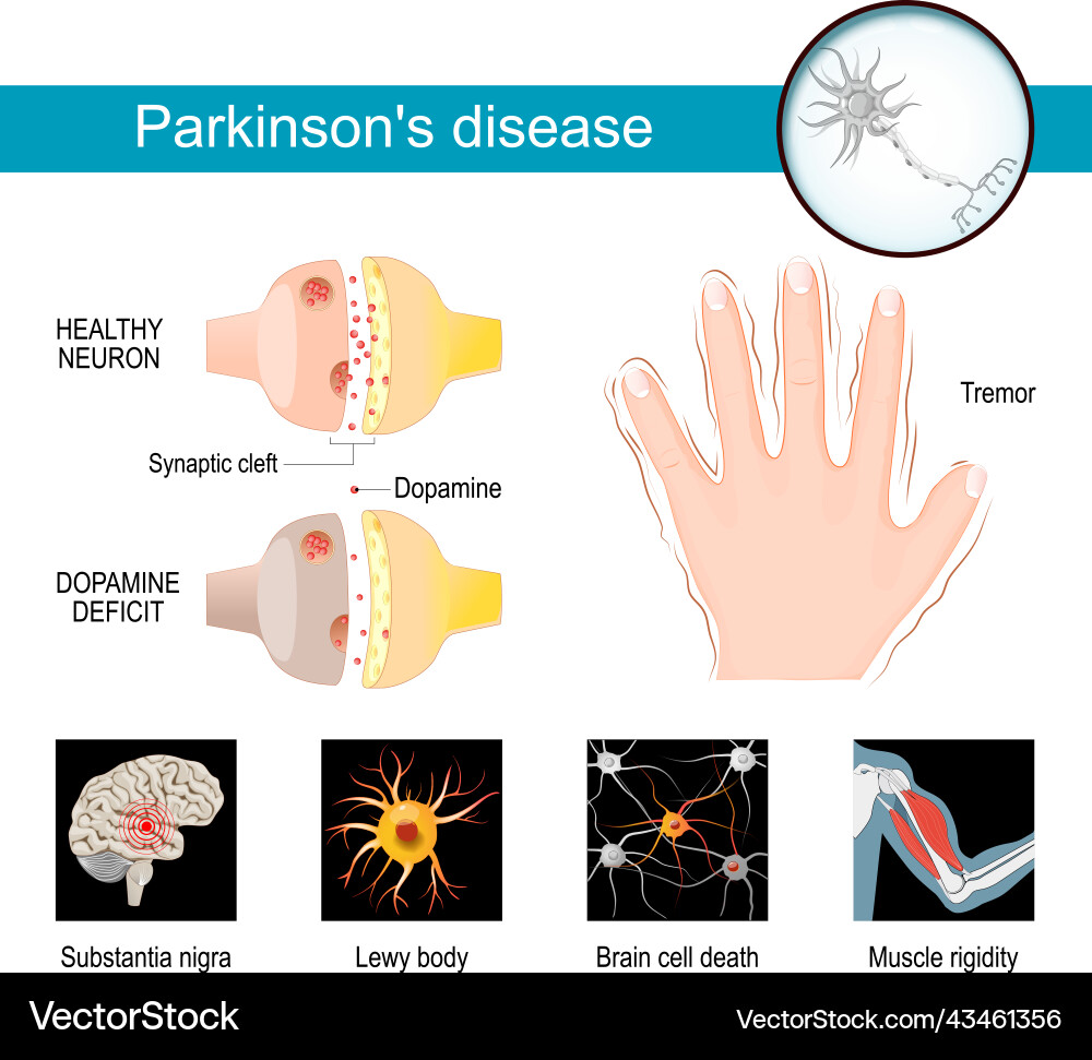 Parkinsons disease infographic symptoms Royalty Free Vector