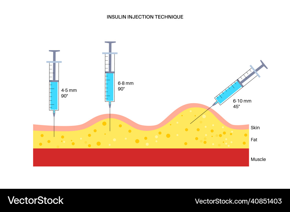 Insulin Injection Technique vector image