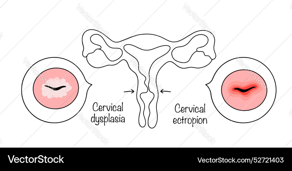 Pathologien des Zervix Pathologien des Zervix vektorbild