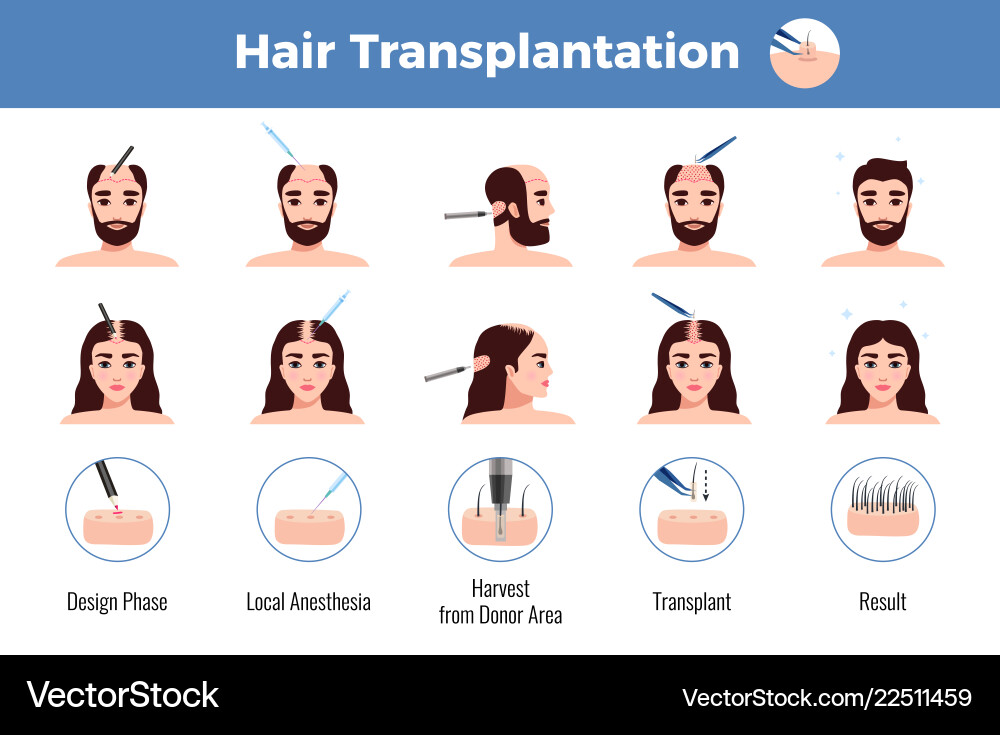 Haartransplantation Männer Frauen Infografik Haartransplantation Männer Frauen Infografik vektorbild