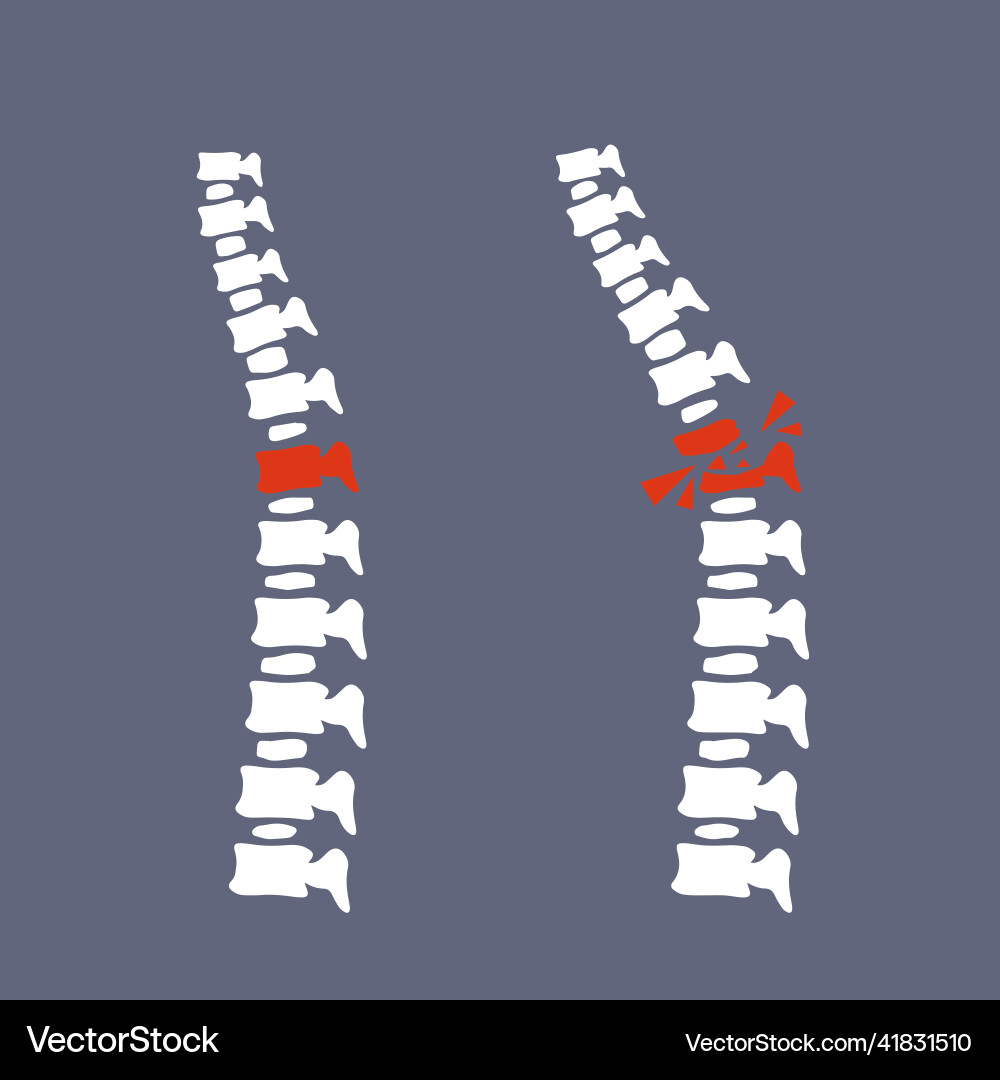 Problems with spine posture issues Problems with spine posture issues vector image