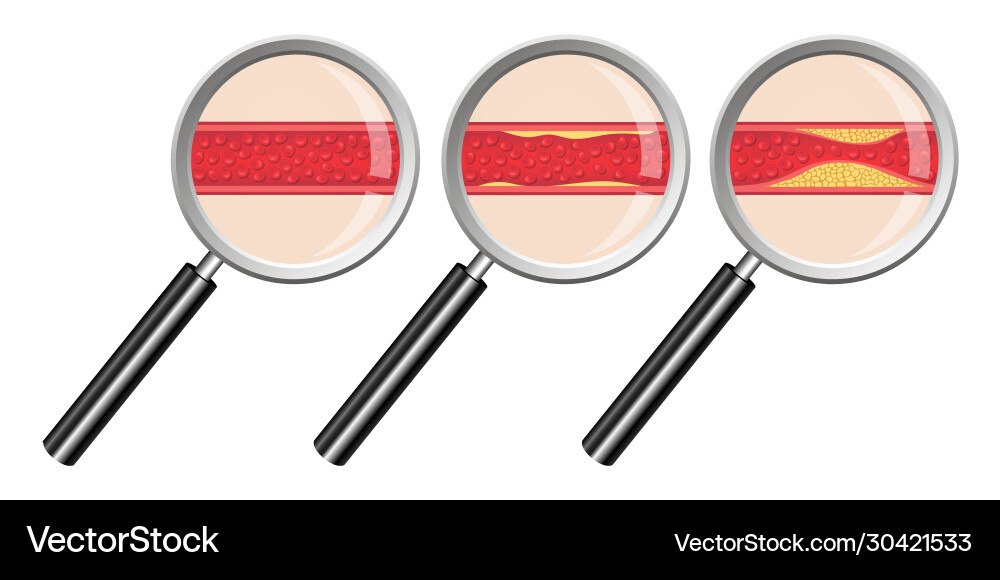 Arteriosclerosis Cardiovascular Disease Vector Image