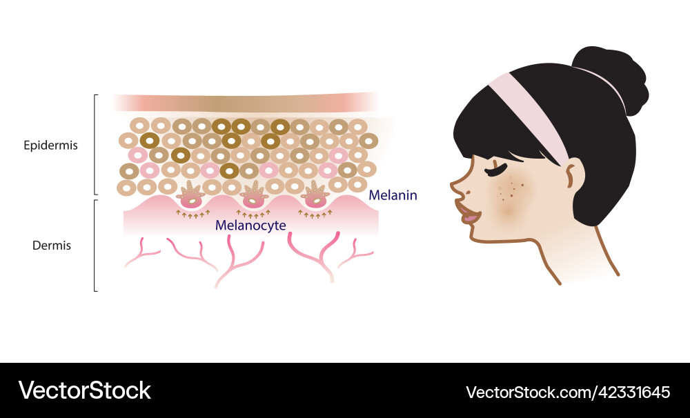 Mechanismus der melasma skin infographic Mechanismus der melasma skin infographic vektorbild