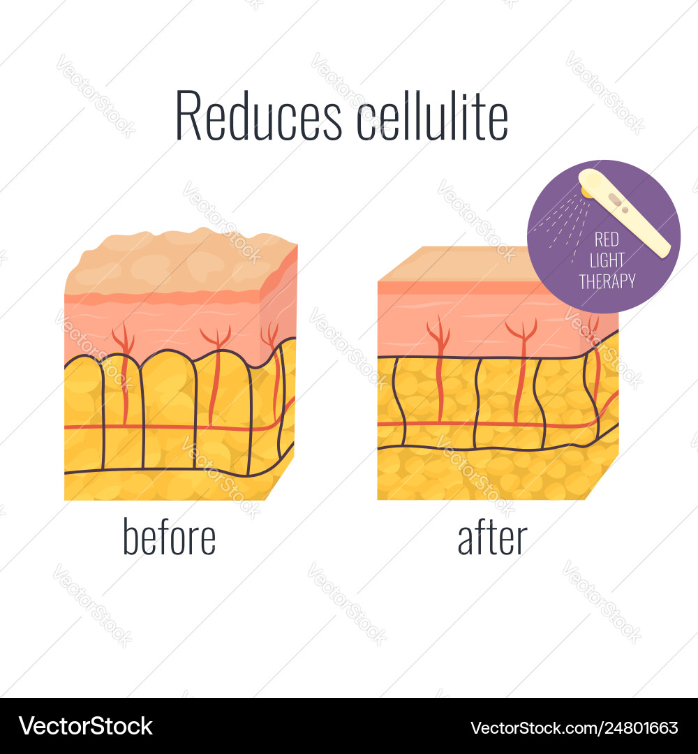 Cell with cellullite and without Cell with cellullite and without vector image