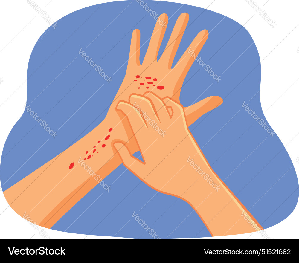 Hands scratching having eczema problems Hands scratching having eczema problems Vector Image