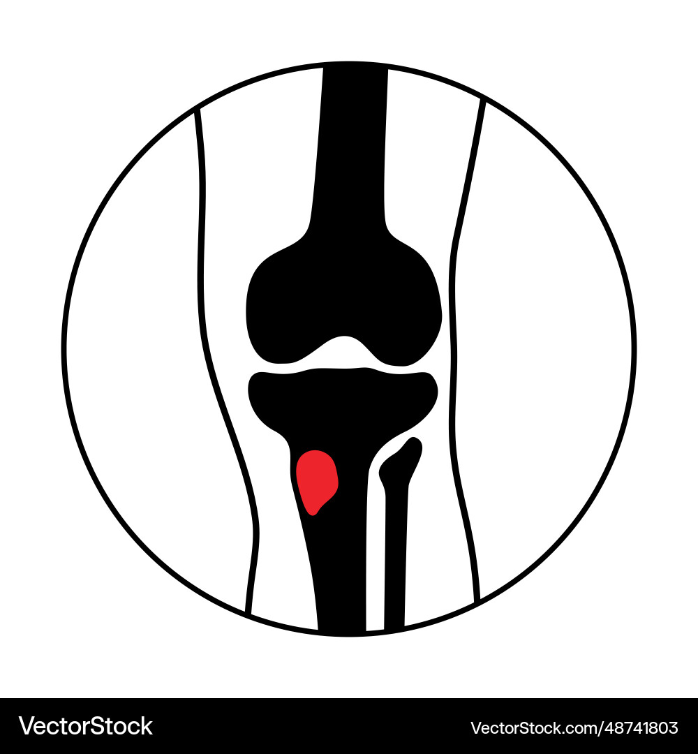 Tibia Knochen Osteomyelitis Tibia Knochen Osteomyelitis vektorbild