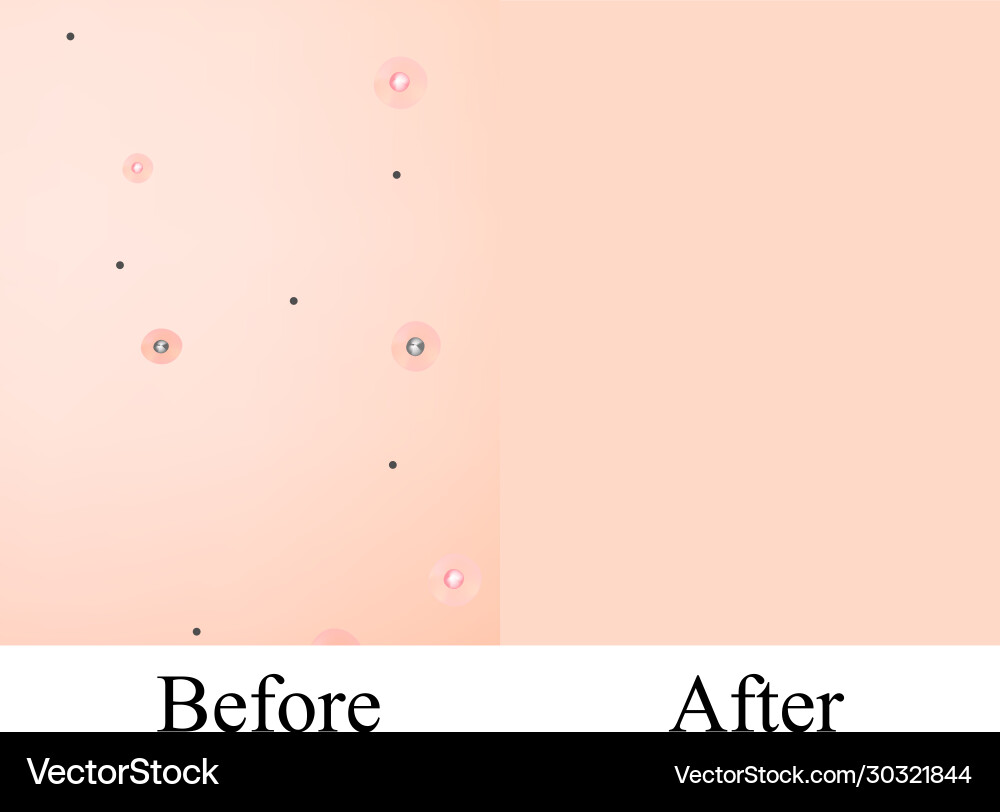 Texture inflamed pimples and acne before after Vector Image