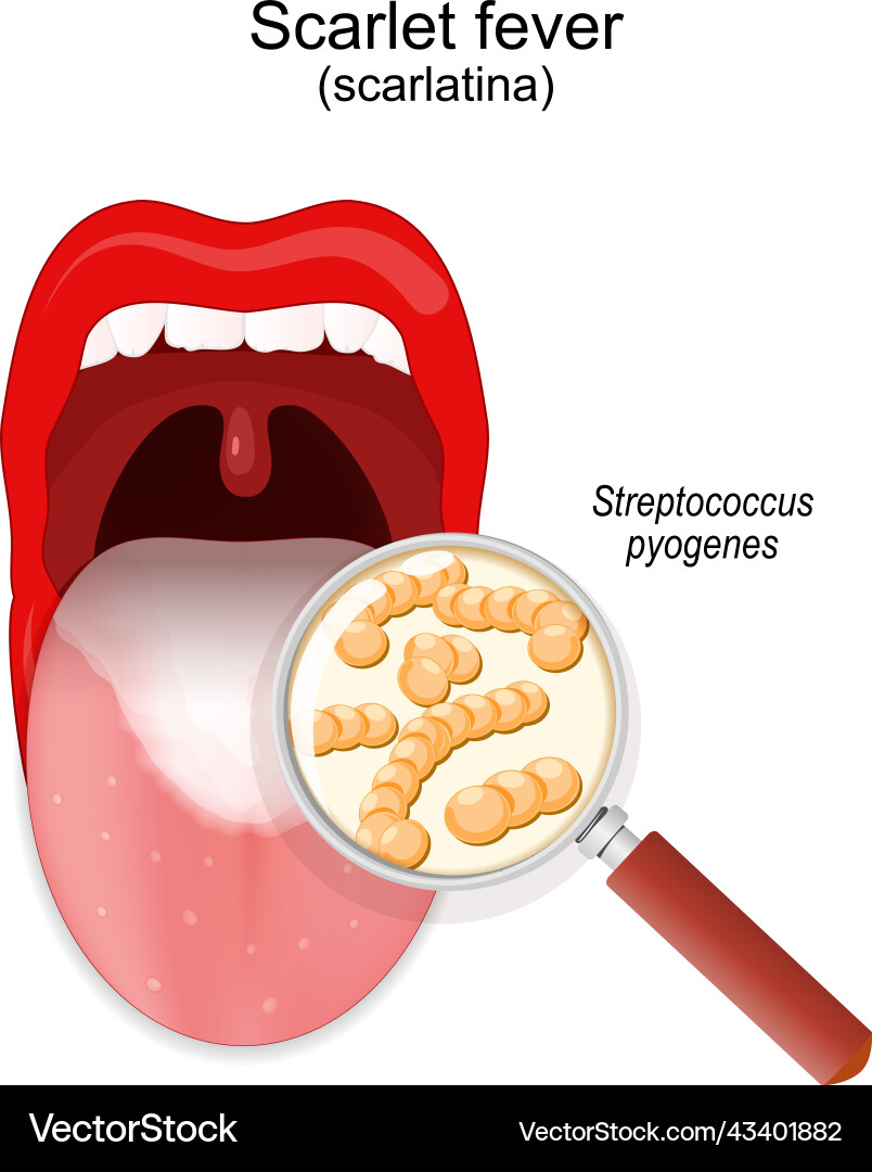Scarlet Fieber Nahaufnahme von Kolonie Streptococcus Scarlet Fieber Nahaufnahme von Kolonie Streptococcus vektorbild