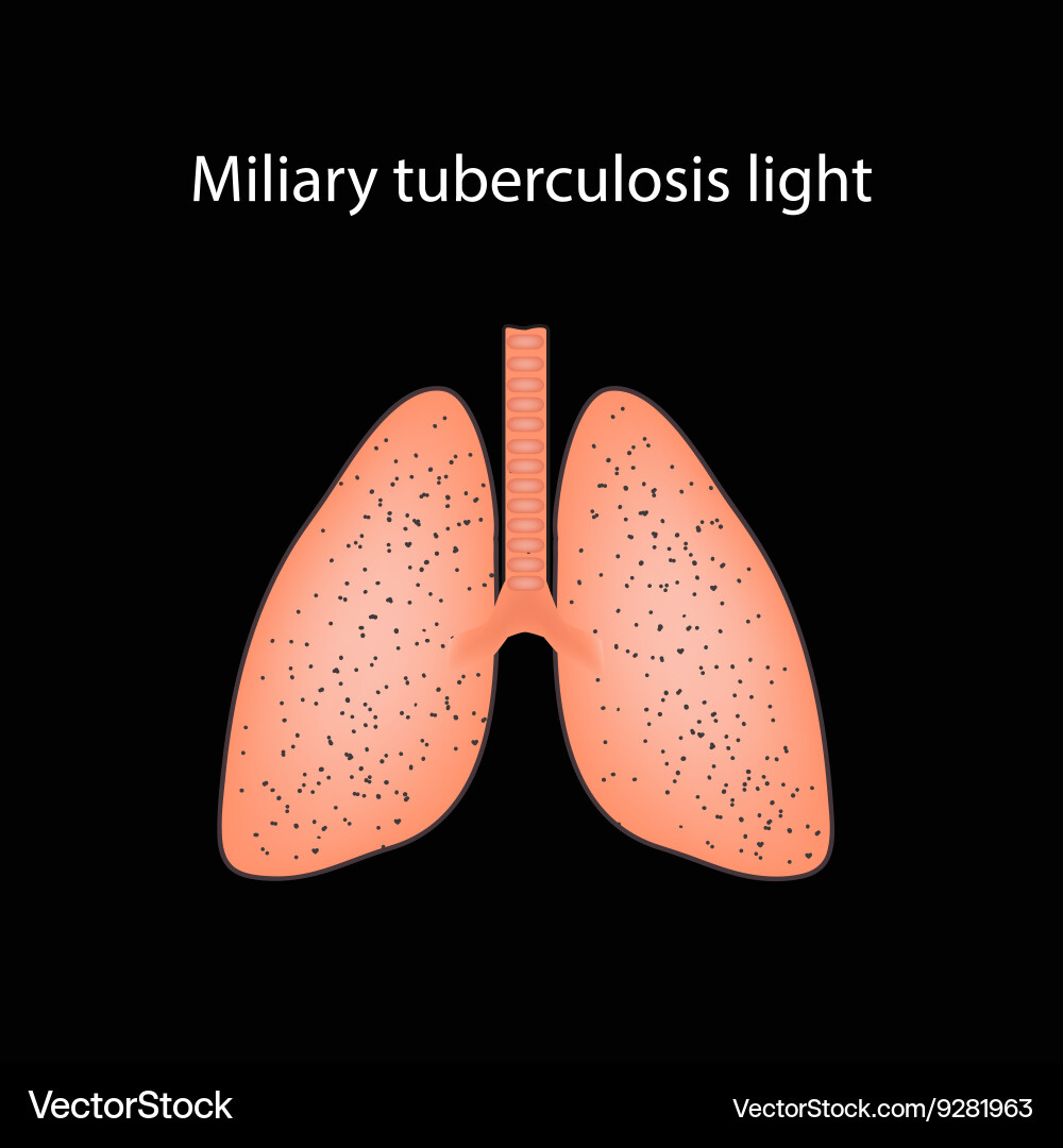 The etiological spectrum of miliary brain lesions: A systematic review of  published cases and case series - Ravindra Kumar Garg, Vimal Paliwal,  Swastika Suvirya, Hardeep Singh Malhotra, Anoop Verma, 2024, image size:1000x1080