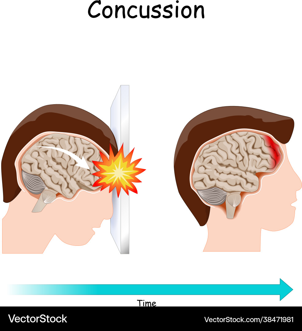 Head Trauma \u0026 Concussion Symptoms – Royalty-Free Vector | VectorStock, image size:985x1080