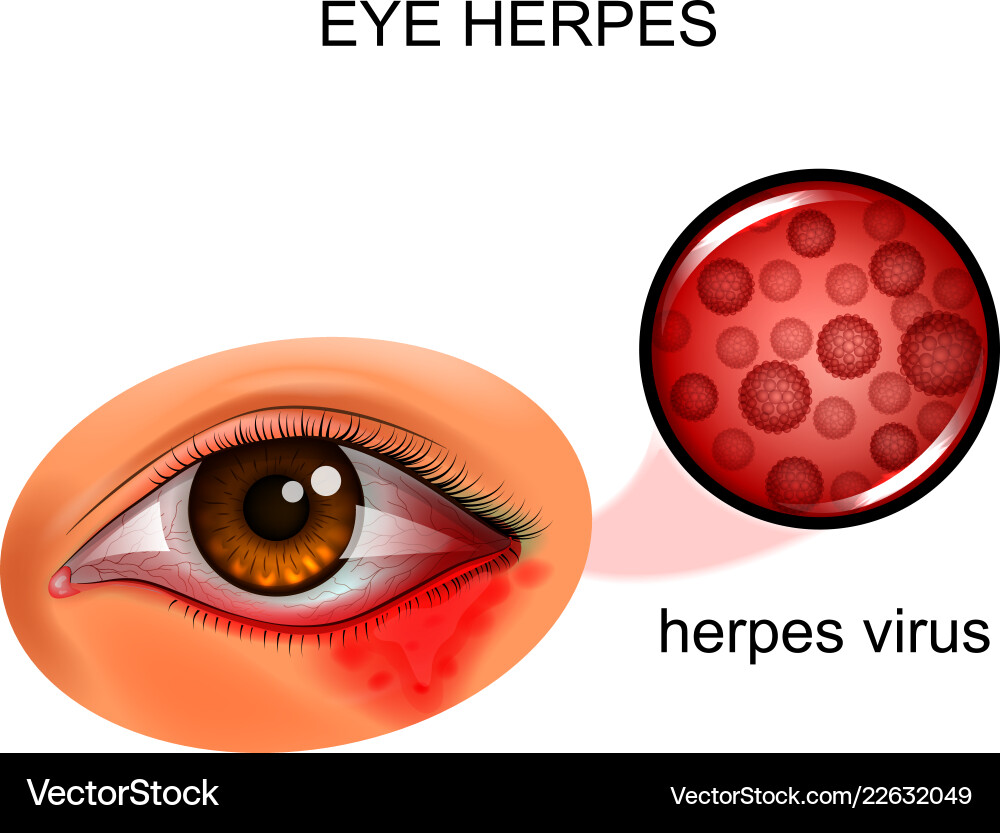 Herpes virus of the eye Herpes virus of the eye vector image