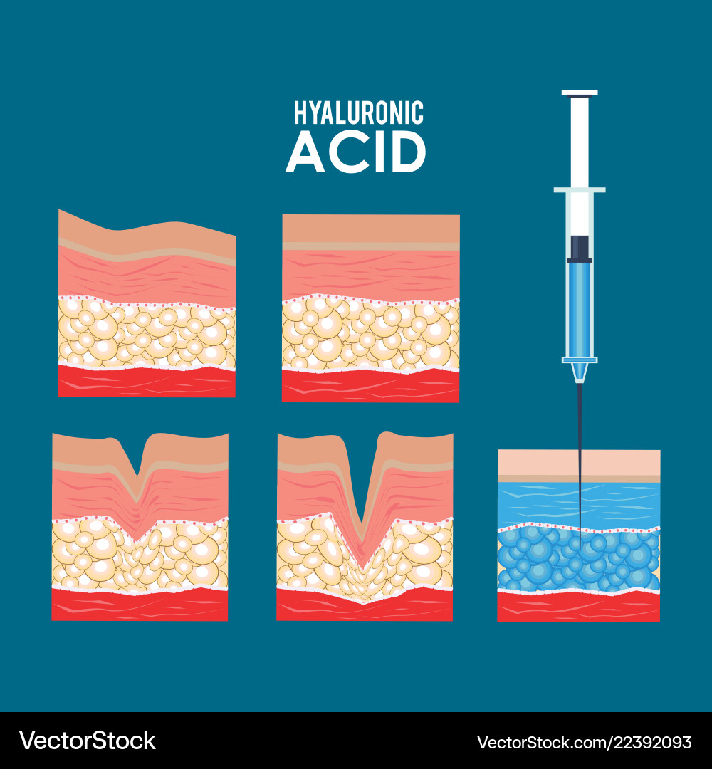 Hyaluronsäure Füllstoff Injektion Infografik Hyaluronsäure Füllstoff Injektion Infografik vektorbild