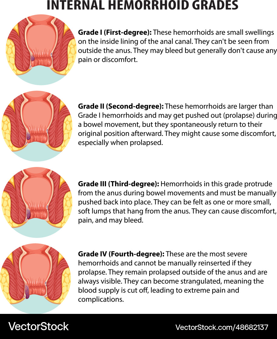 Educational infographic internal hemorrhoid grades vector image