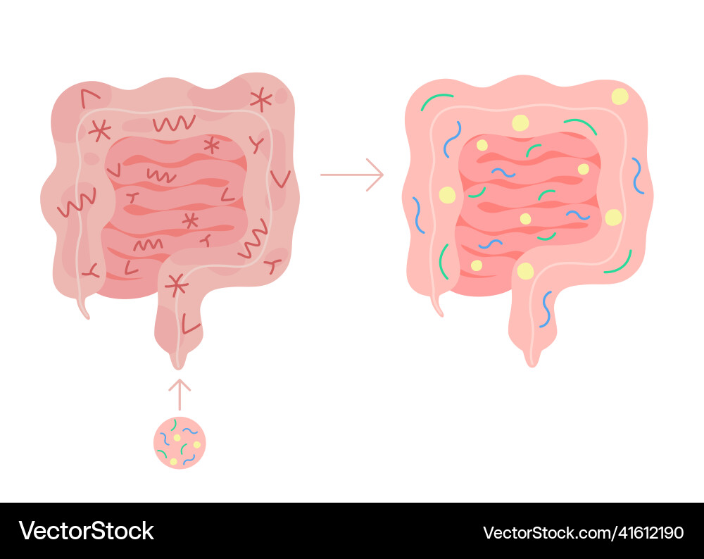 Fecal microbiota transplant from healthy Fecal microbiota transplant from healthy Vector Image