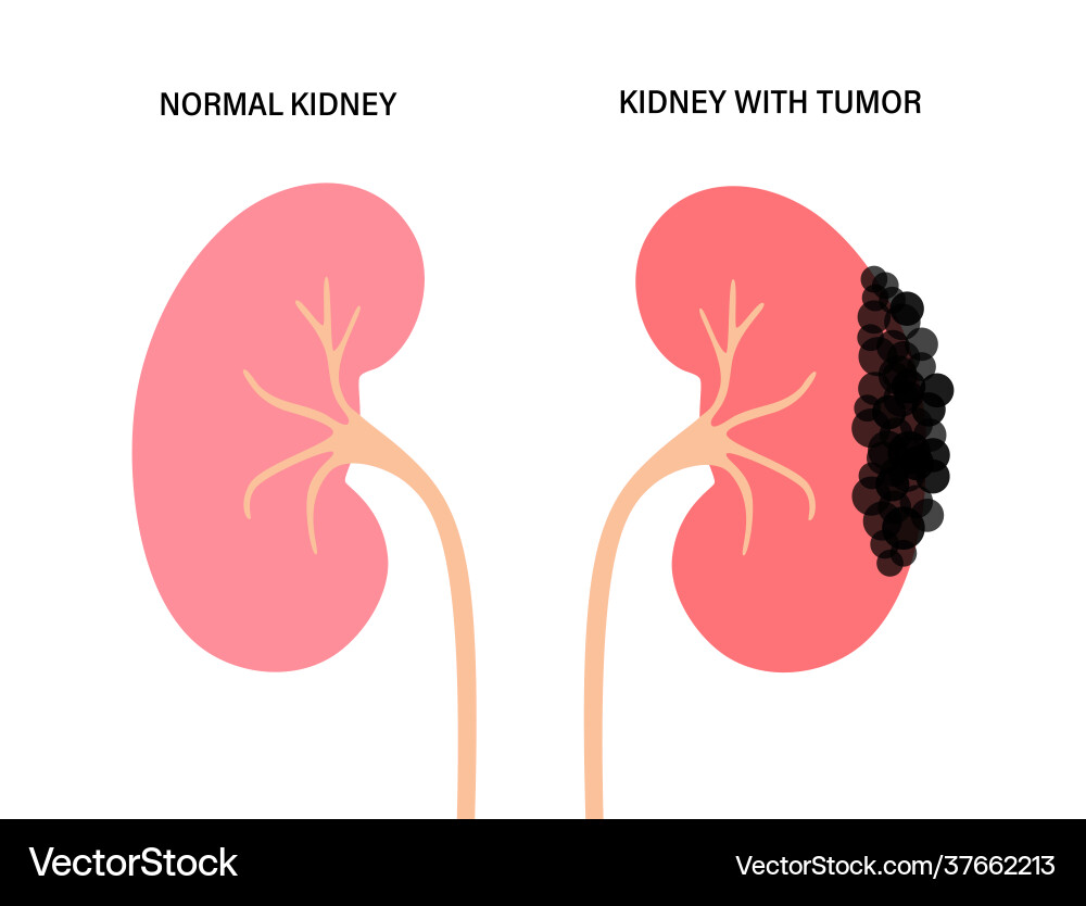 Kidney disease concept Kidney disease concept Vector Image
